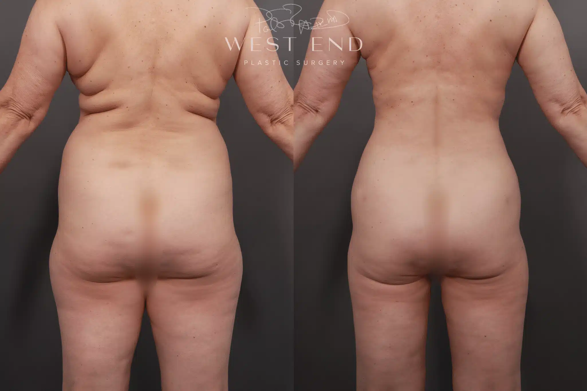 Liposuction Washington DC