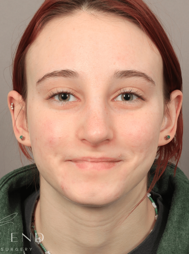 After Image: Open Rhinoplasty (8.5 Months Post-op) - front