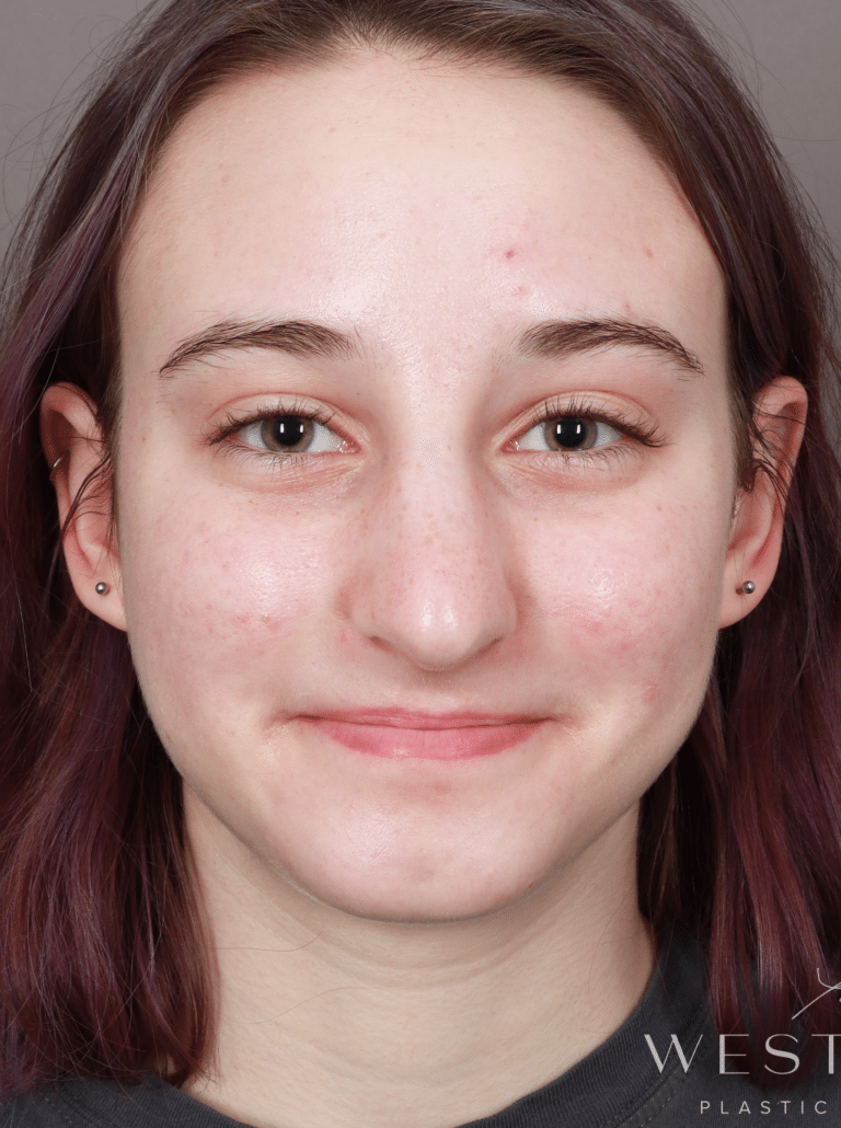 Before Image: Open Rhinoplasty (8.5 Months Post-op) - front