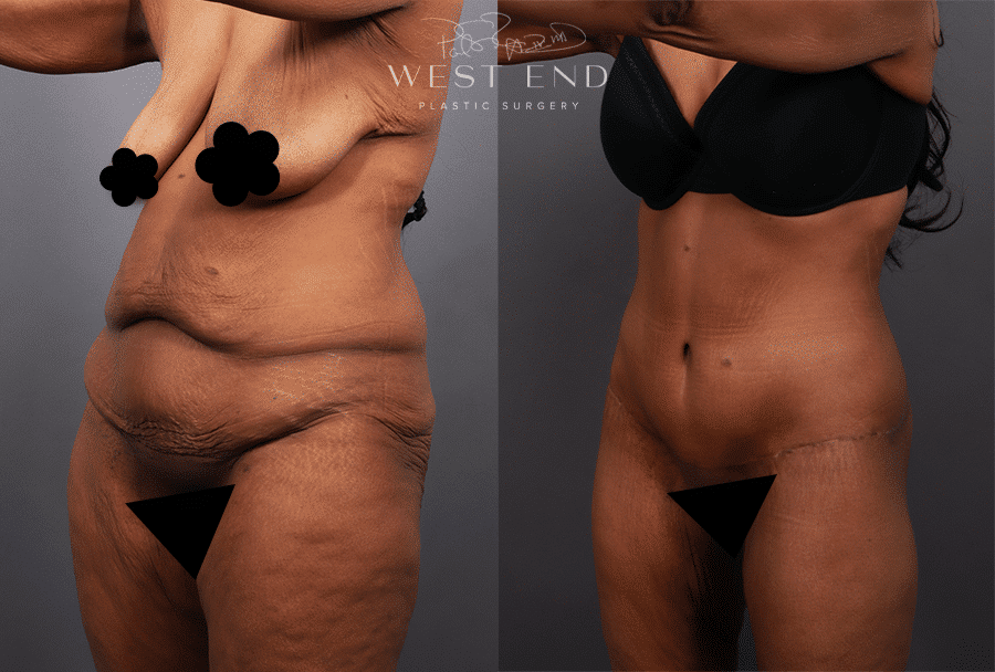 Abdominoplasty Procedure Washington DC