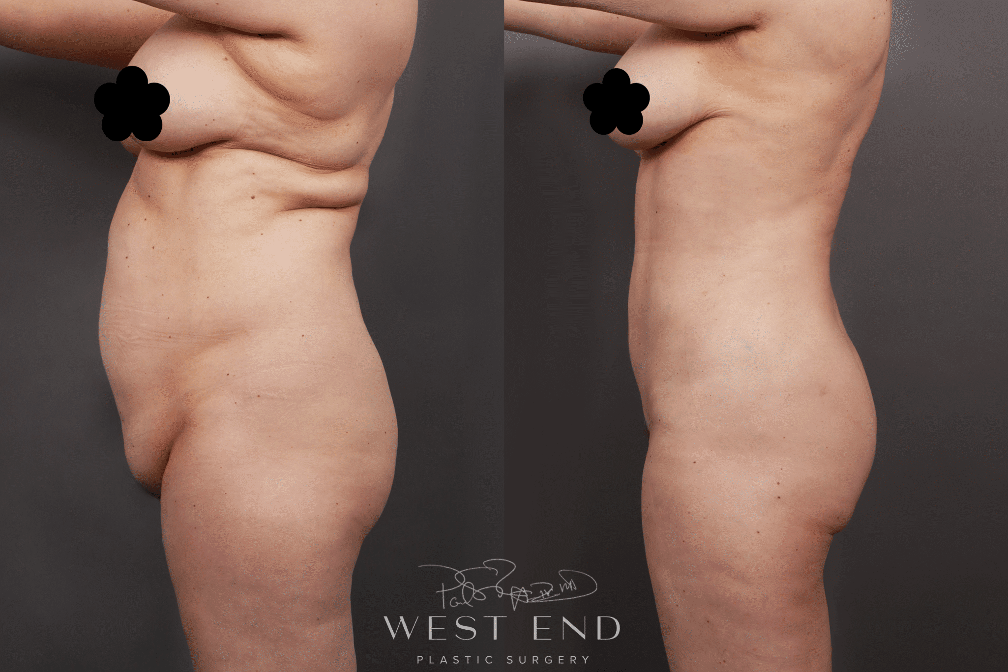 Tummy Tuck Surgery Washington DC
