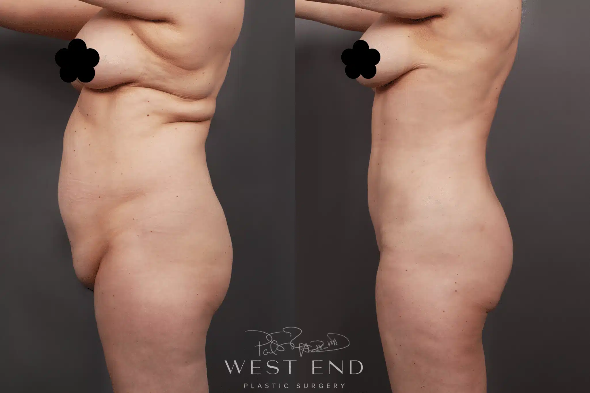 VASERLipo Surgery Washington DC