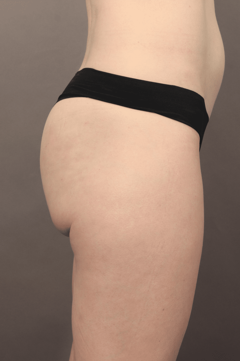 After Image: Non-Surgical Butt Lift (BBL) - right-side