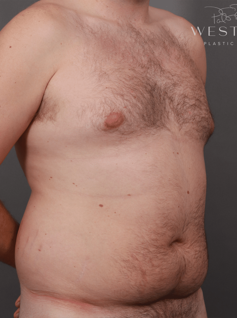 Before Image: Liposuction and Renuvion Skin Tightening (5 Months Post-Op) - right-front-oblique