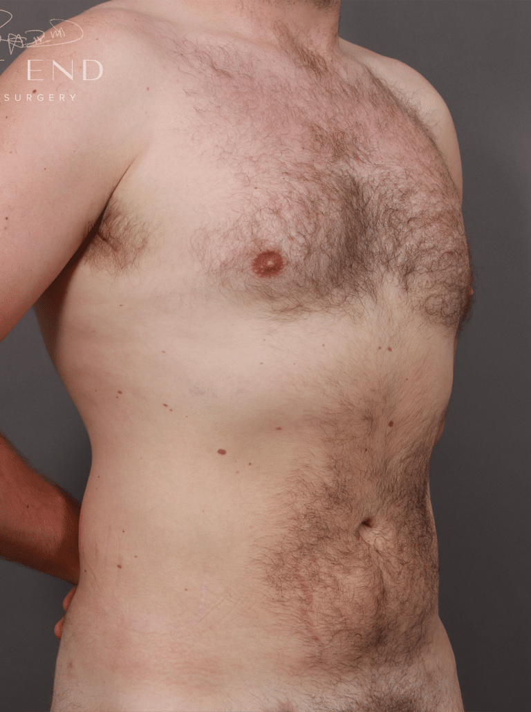 After Image: Liposuction and Renuvion Skin Tightening (5 Months Post-Op) - right-front-oblique