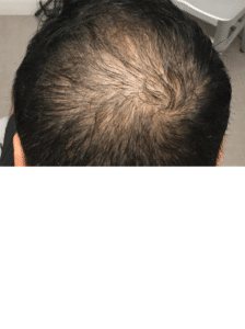 Non-Surgical Hair Restoration (with PRP)