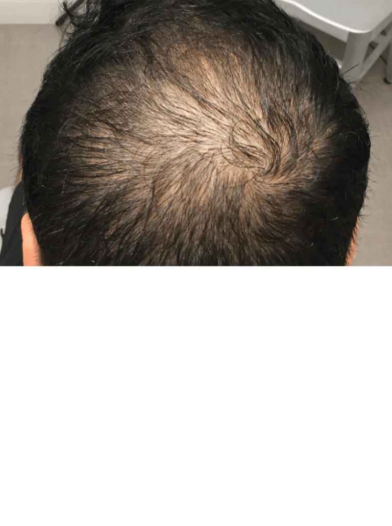 Before Image: Non-Surgical Hair Restoration (with PRP) - back