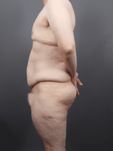 Post Weight Loss: Lower Body Lift, Liposuction & Renuvion Skin Tightening (1 Month Post-op)