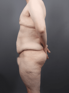 Before Image: Post Weight Loss: Lower Body Lift, Liposuction & Renuvion Skin Tightening (1 Month Post-op)