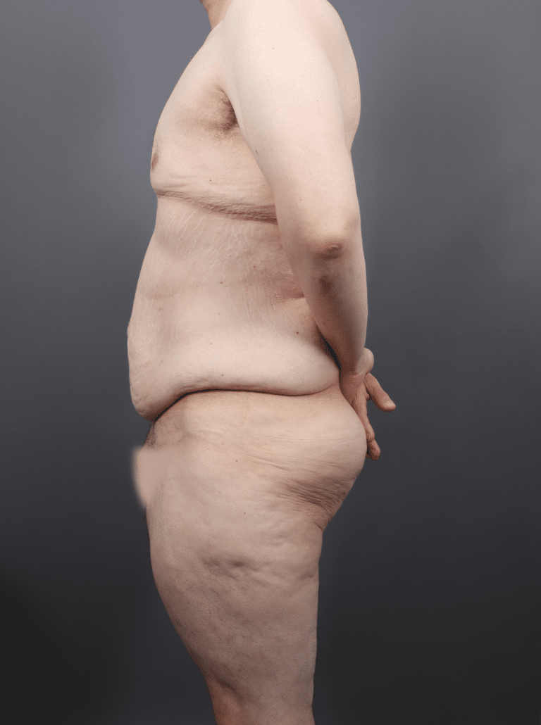Before Image: Post Weight Loss: Lower Body Lift, Liposuction & Renuvion Skin Tightening (1 Month Post-op) - left-side