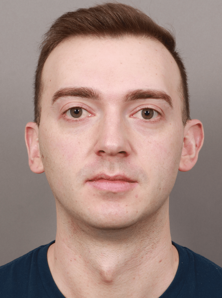 Before Image: Chin & Jaw Implants (7 Months Post-op) - front