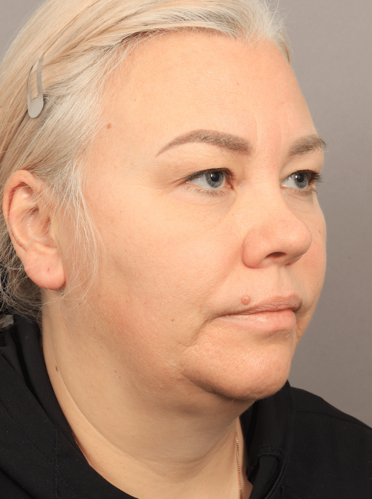Before Image: Neck Lift with Platysmaplasty, Upper Eyelid Lift, Brow Lift, and CO2 Resurfacing (2 Months post-op) - right-front-oblique