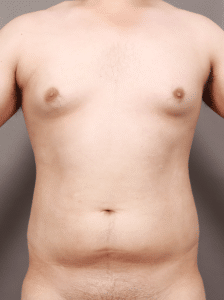 Before Image: Liposuction and Renuvion Skin Tightening (7 Months Post-op)
