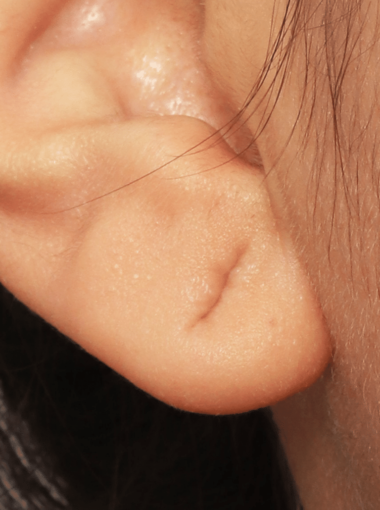 Before Image: Earlobe Repair (4 Months Post-op) - left-side