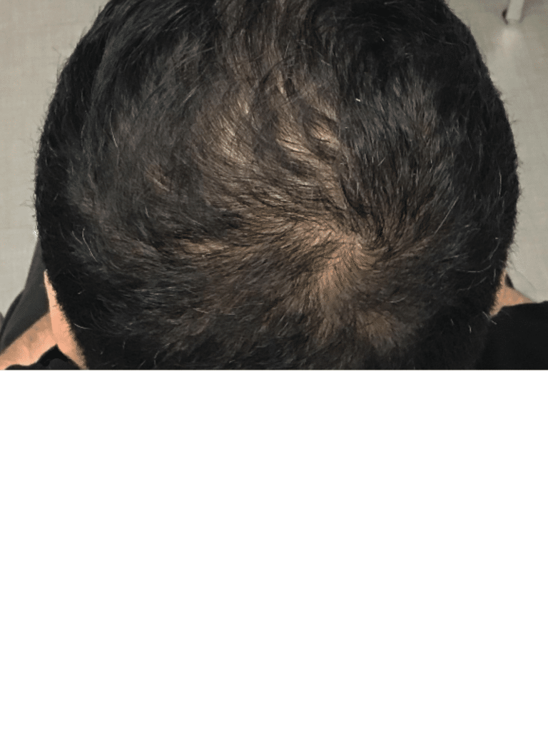 After Image: Non-Surgical Hair Restoration (with PRP) - back