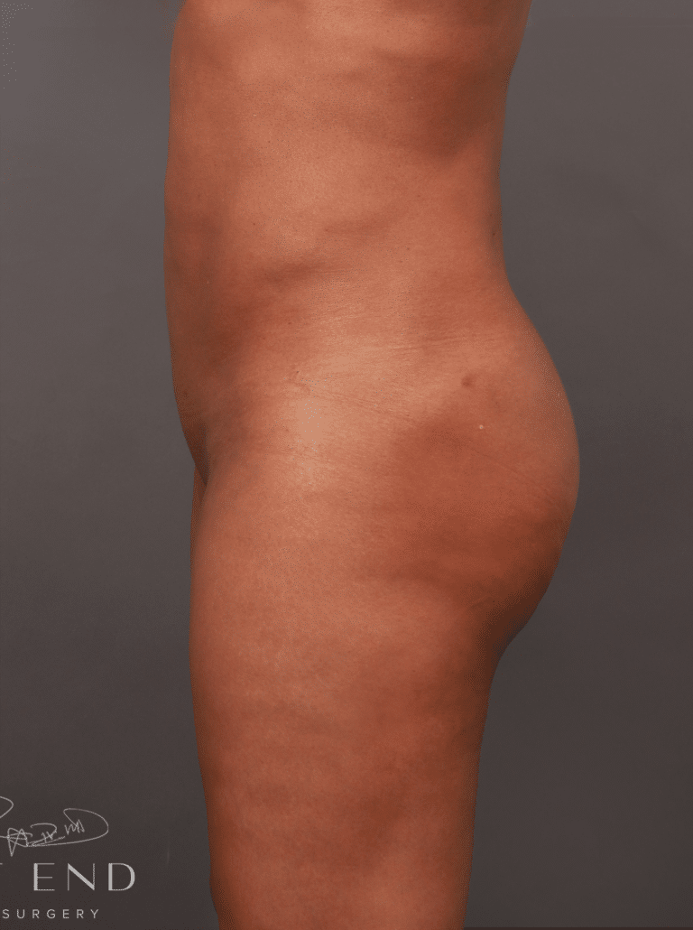 After Image: Brazilian Butt Lift & Liposuction (2 Years Post-op) - left-side
