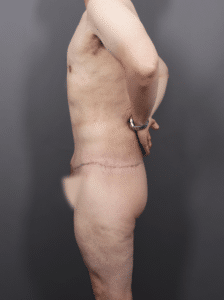 After Image: Post Weight Loss: Lower Body Lift, Liposuction & Renuvion Skin Tightening (1 Month Post-op)