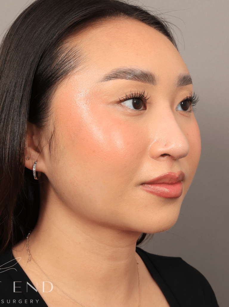 After Image: Submental Liposuction, Renuvion, and Rhinoplasty (3 Months Post-op) - right-front-oblique