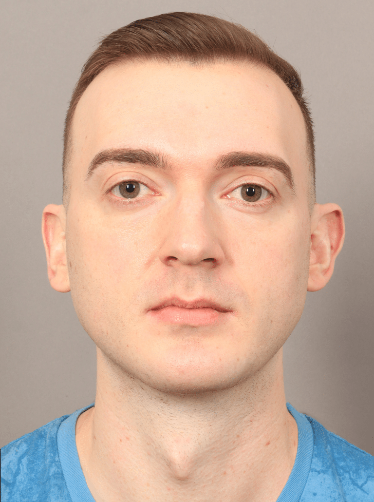 After Image: Chin & Jaw Implants (7 Months Post-op) - front