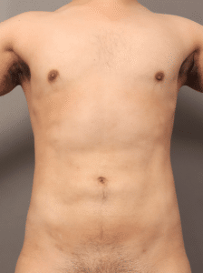 After Image: Liposuction and Renuvion Skin Tightening (7 Months Post-op)