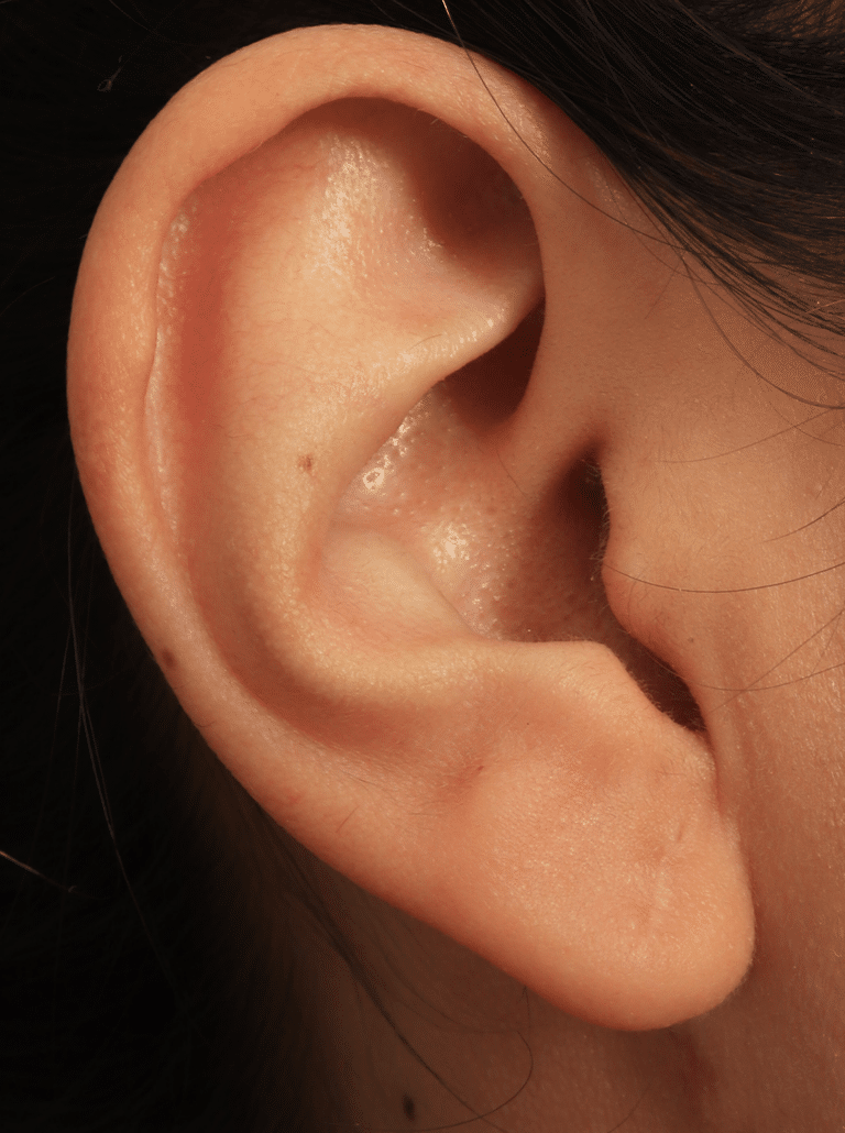 After Image: Earlobe Repair (4 Months Post-op) - left-side