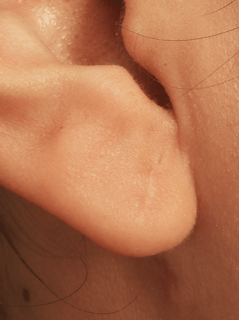 After Image: Earlobe Repair (4 Months Post-op) - left-side