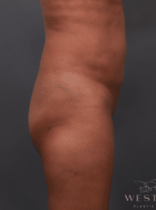 Brazilian Butt Lift & Liposuction (2 Years Post-op)