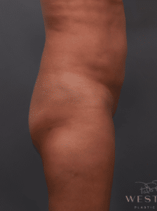 Before Image: Brazilian Butt Lift & Liposuction (2 Years Post-op)