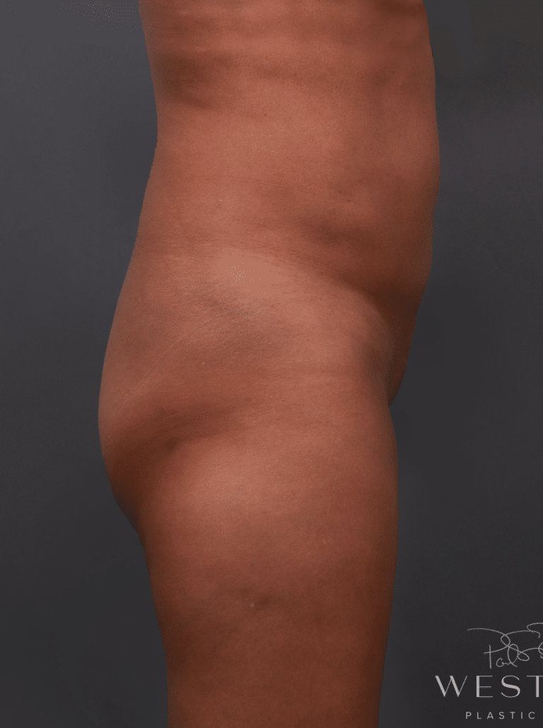 Before Image: Brazilian Butt Lift & Liposuction (2 Years Post-op) - right-side