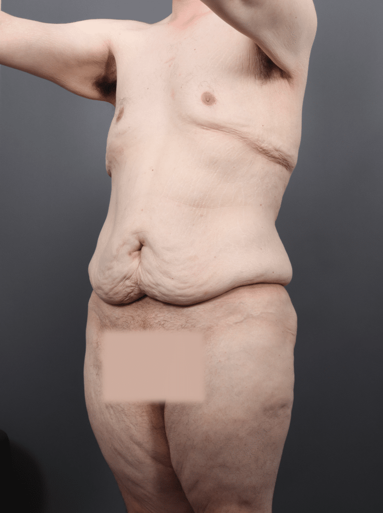Before Image: Post Weight Loss: Lower Body Lift, Liposuction & Renuvion Skin Tightening (1 Month Post-op) - left-front-oblique