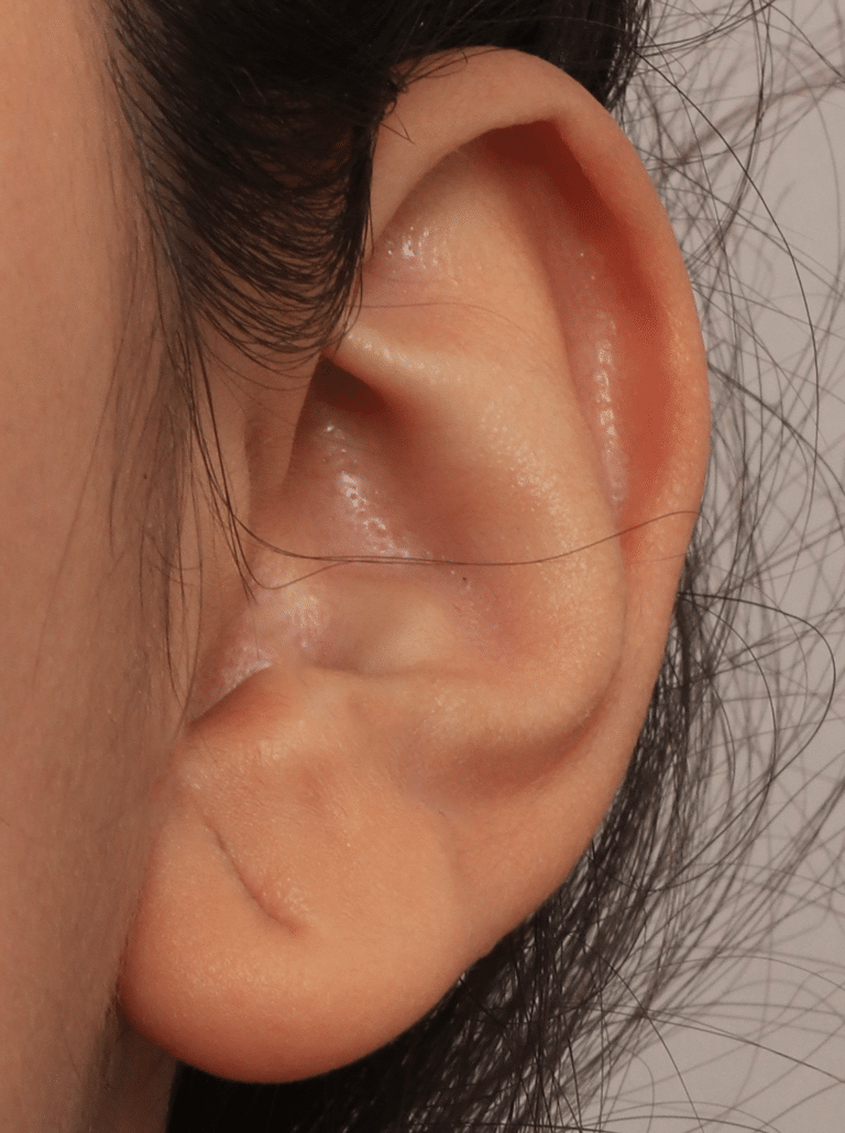 Before Image: Earlobe Repair (4 Months Post-op) - left-side