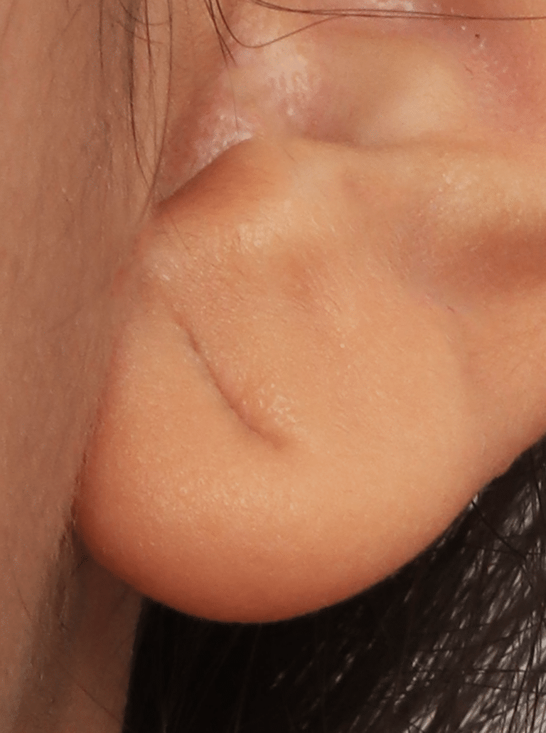 Before Image: Earlobe Repair (4 Months Post-op) - right-side