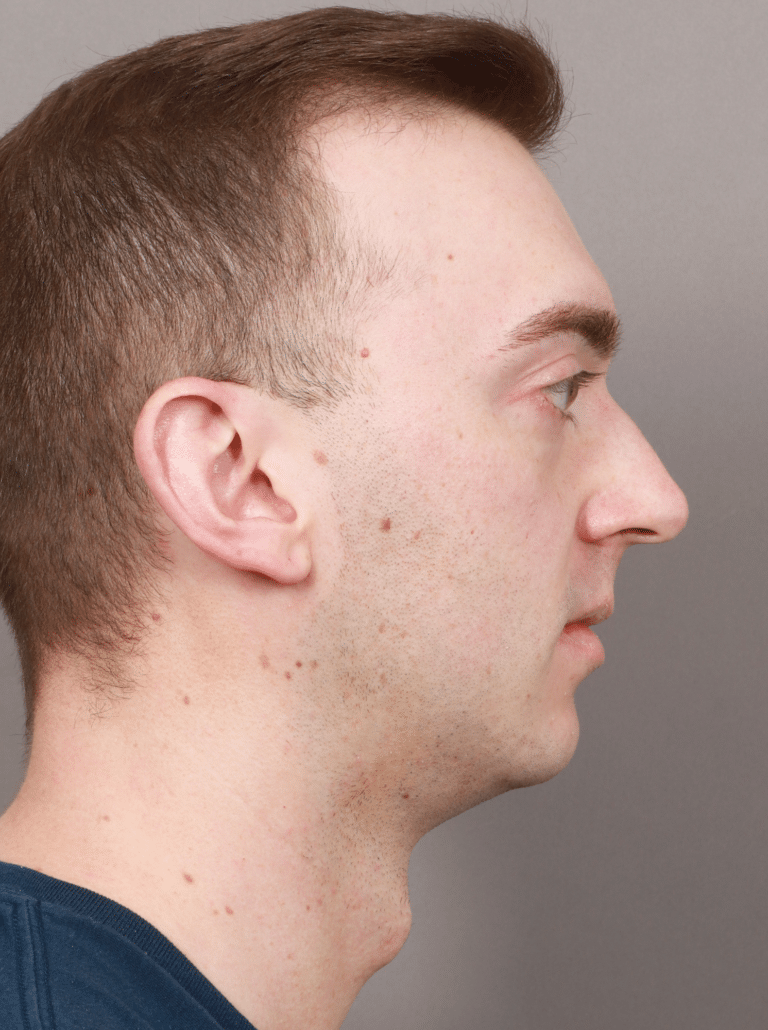 Before Image: Chin & Jaw Implants (7 Months Post-op) - right-side