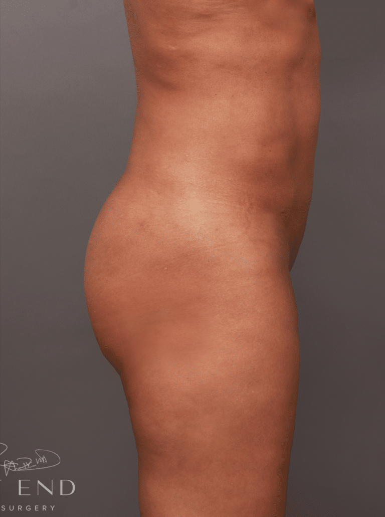 After Image: Brazilian Butt Lift & Liposuction (2 Years Post-op) - right-side