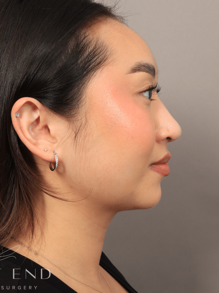 After Image: Submental Liposuction, Renuvion, and Rhinoplasty (3 Months Post-op) - right-side