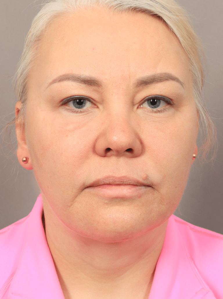 After Image: Neck Lift with Platysmaplasty, Upper Eyelid Lift, Brow Lift, and CO2 Resurfacing (2 Months post-op) - front