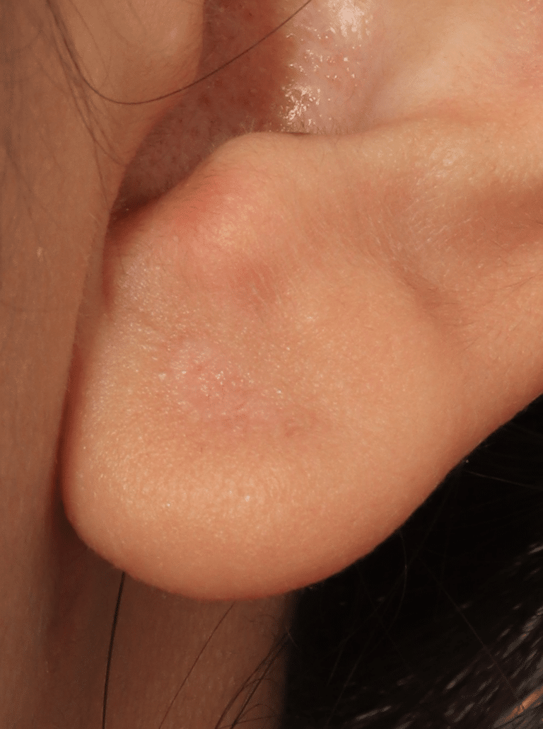 After Image: Earlobe Repair (4 Months Post-op) - right-side