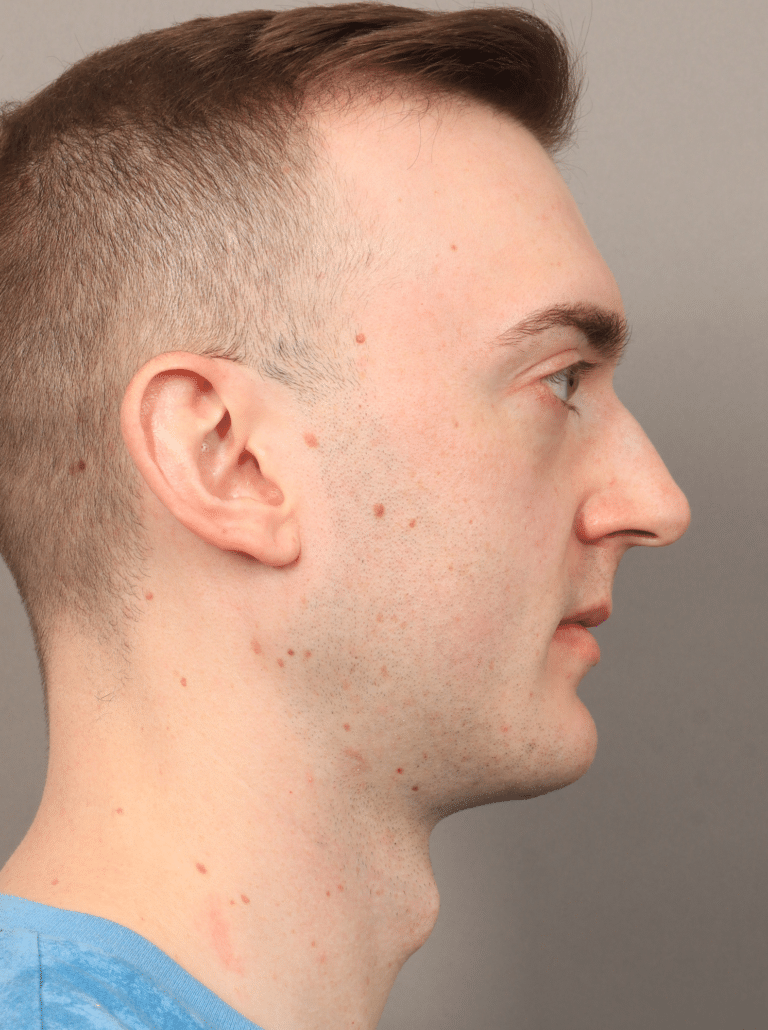 After Image: Chin & Jaw Implants (7 Months Post-op) - right-side