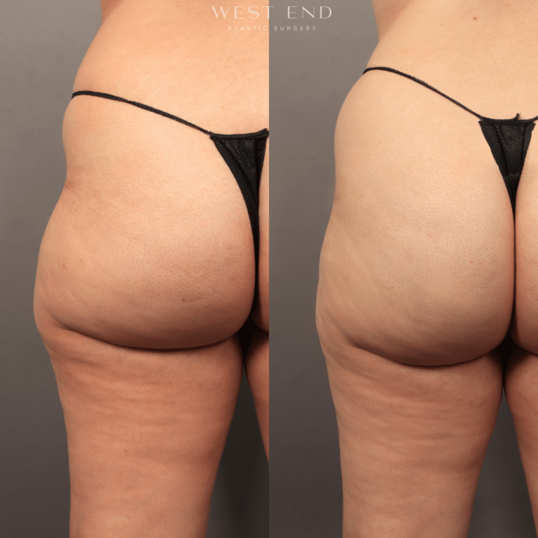 Before and After Image of Radiesse® Washington DC
