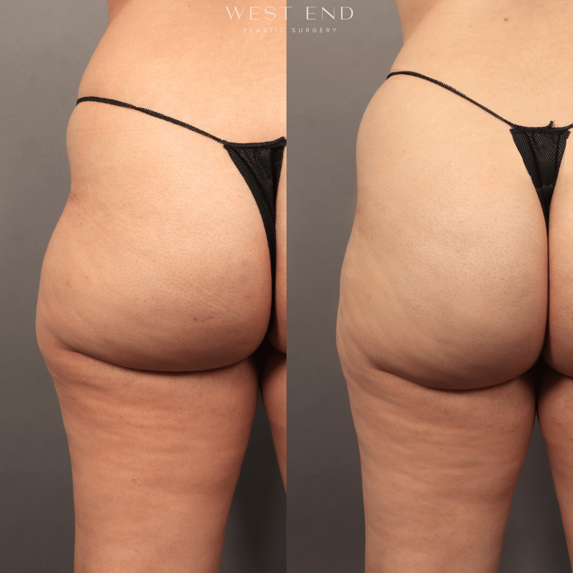 Before and After Image of Radiesse® Washington DC