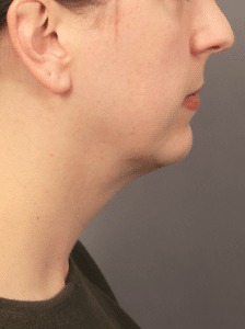 Before Image: Liposuction, Renuvion, and Facial Implants (4.5 Months Post-op)