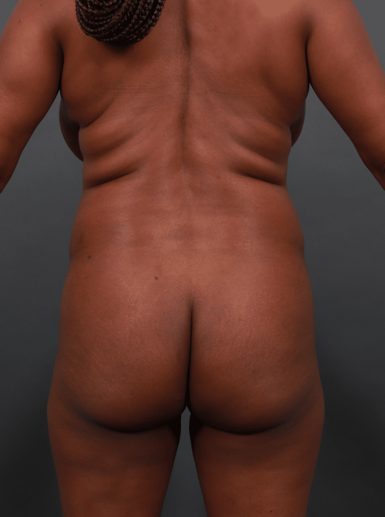 Before Image: Liposuction, Renuvion Skin Tightening, and Brazilian Butt Lift - front