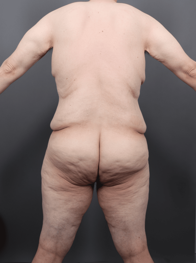 Before Image: Post Weight Loss: Lower Body Lift, Liposuction & Renuvion Skin Tightening (1 Month Post-op) - back