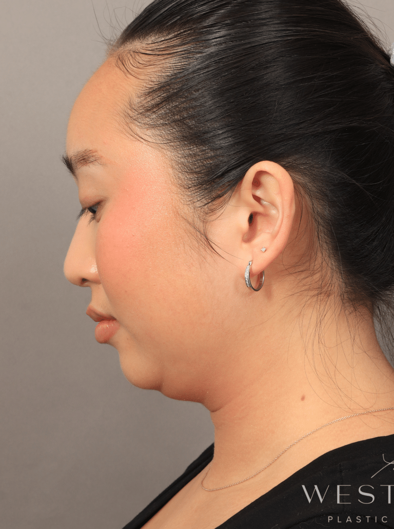 Before Image: Submental Liposuction, Renuvion, and Rhinoplasty (3 Months Post-op) - left-side