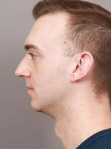 Before Image: Chin & Jaw Implants (7 Months Post-op)
