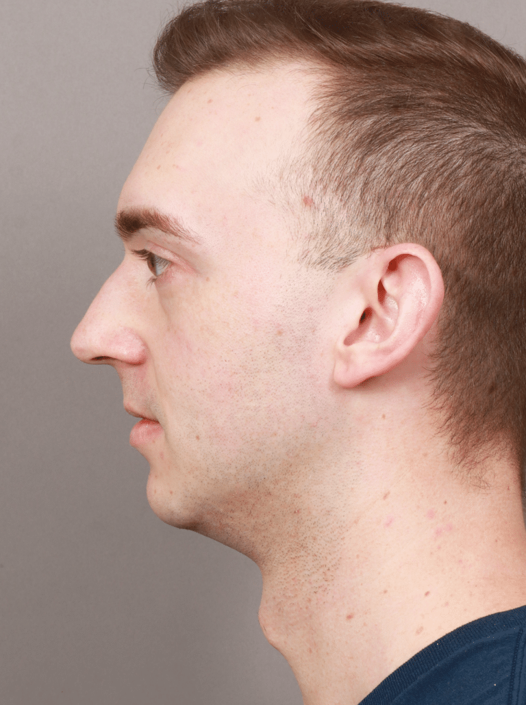 Before Image: Chin & Jaw Implants (7 Months Post-op) - left-side