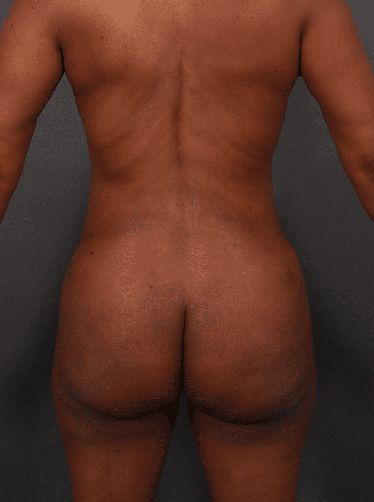 After Image: Liposuction, Renuvion Skin Tightening, and Brazilian Butt Lift - front