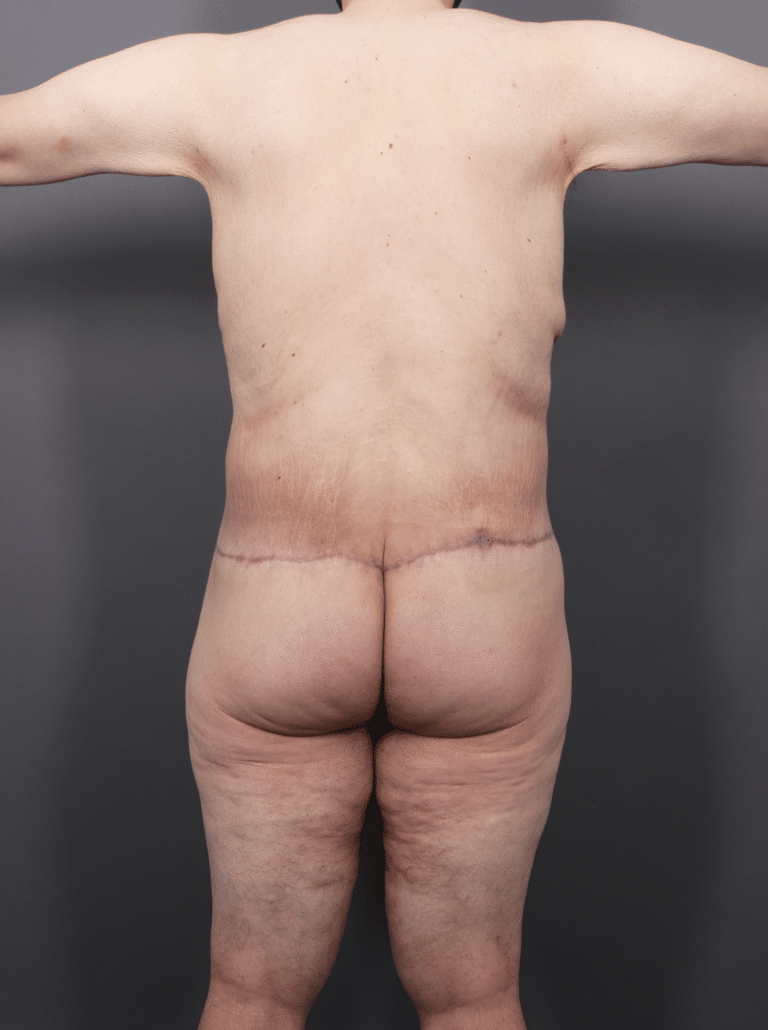 After Image: Post Weight Loss: Lower Body Lift, Liposuction & Renuvion Skin Tightening (1 Month Post-op) - back