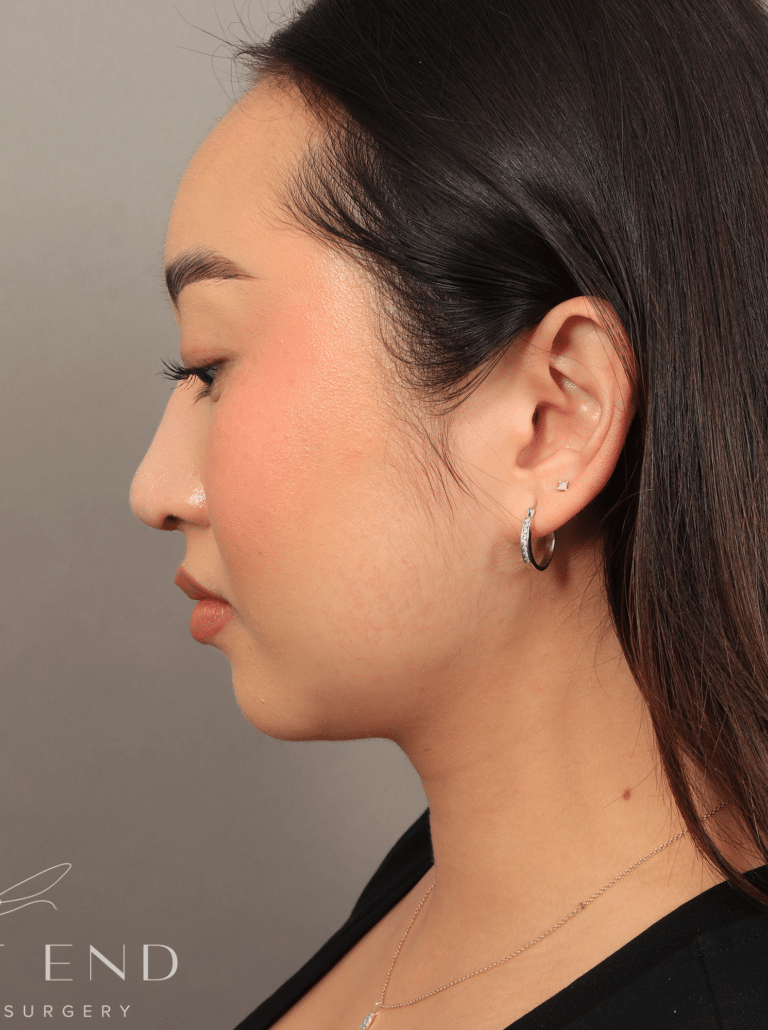 After Image: Submental Liposuction, Renuvion, and Rhinoplasty (3 Months Post-op) - left-side