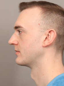 Chin & Jaw Implants (7 Months Post-op)